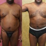 Male Liposuction Abdomen Before & After Patient #12523
