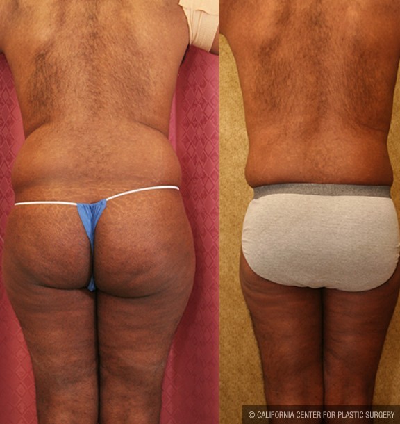 Male Liposuction Abdomen Before & After Patient #12527