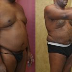 Male Liposuction Abdomen Before & After Patient #12523