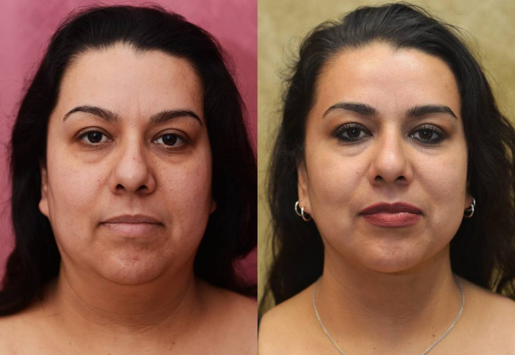 Neck & Face Liposuction Before & After Patient #12502