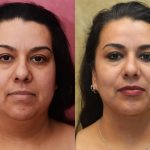 Neck & Face Liposuction Before & After Patient #12502