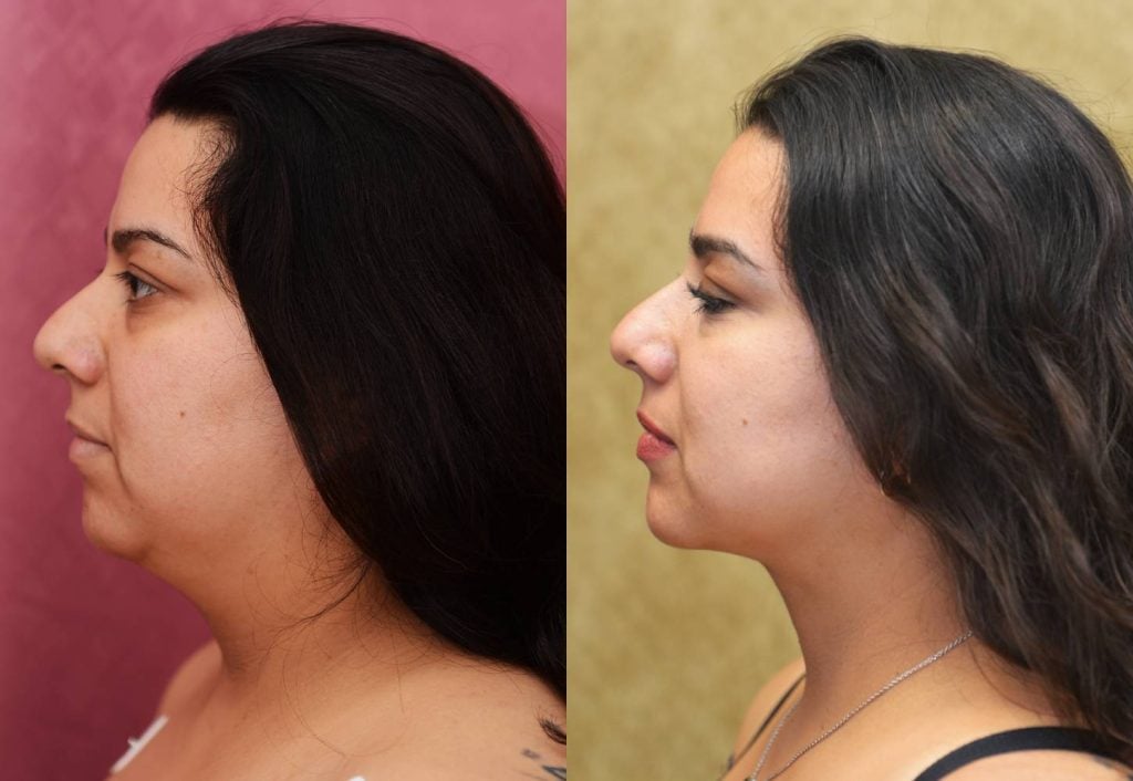 Neck & Face Liposuction Before & After Patient #12502