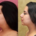 Neck & Face Liposuction Before & After Patient #12502