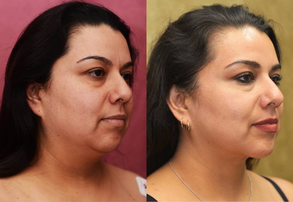 Neck & Face Liposuction Before & After Patient #12502