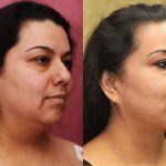 Neck & Face Liposuction Before & After Patient #12502