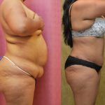 African American Tummy Tuck (Abdominoplasty) Before & After Patient #12572