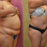 African American Tummy Tuck (Abdominoplasty) Before & After Patient #12572