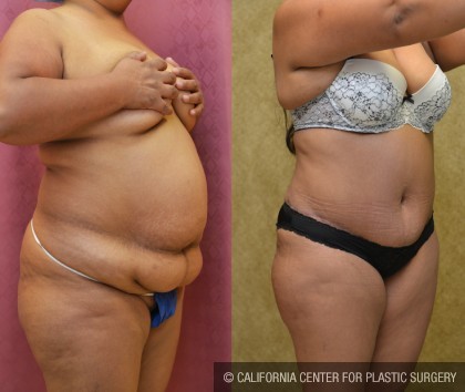 African American Tummy Tuck (Abdominoplasty) Before & After Patient #12572