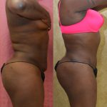 African American Tummy Tuck (Abdominoplasty) Before & After Patient #12551
