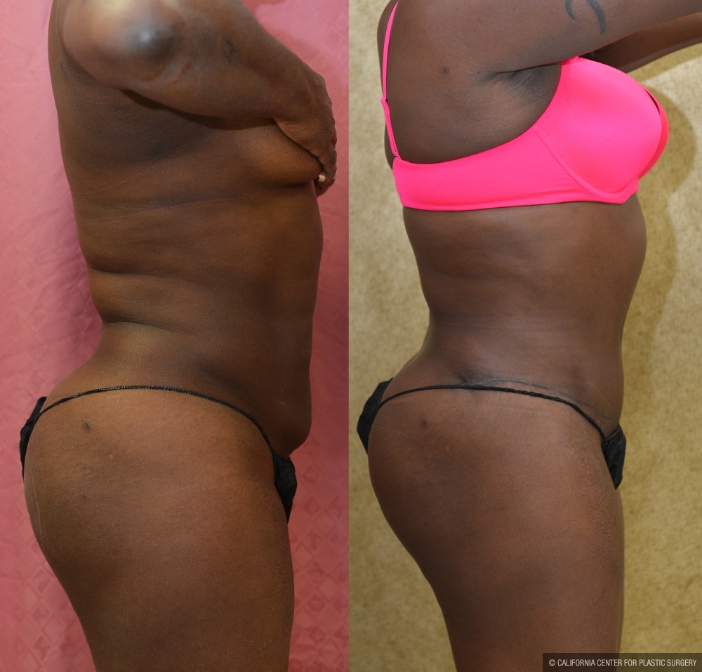 African American Tummy Tuck (Abdominoplasty) Before & After Patient #12551