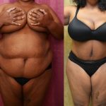 African American Tummy Tuck (Abdominoplasty) Before & After Patient #12546