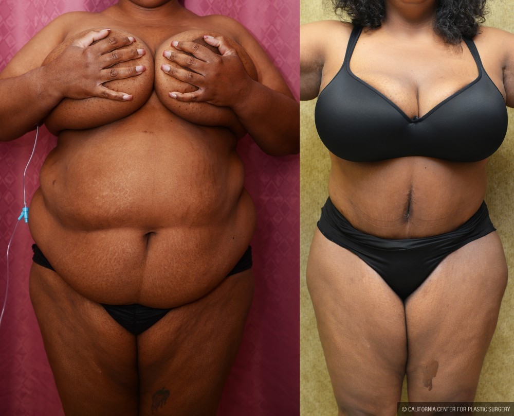African American Tummy Tuck (Abdominoplasty) Before & After Patient #12546