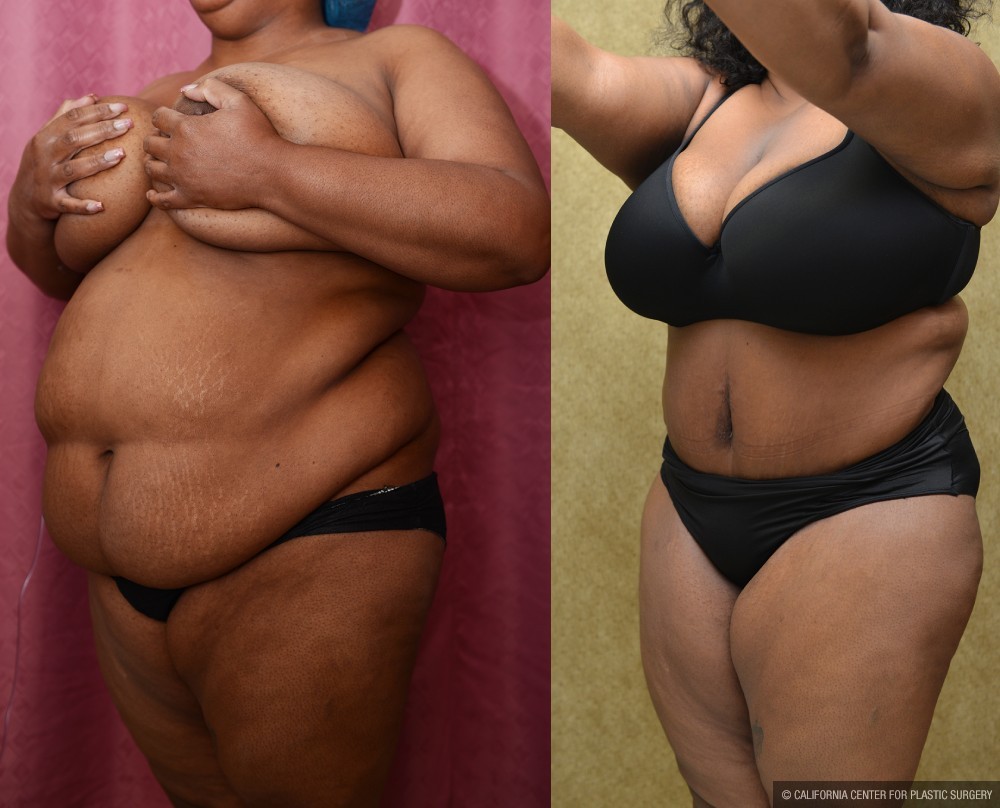 African American Tummy Tuck (Abdominoplasty) Before & After Patient #12546