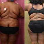 African American Tummy Tuck (Abdominoplasty) Before & After Patient #12546