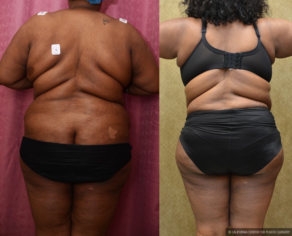 African American Tummy Tuck (Abdominoplasty) Before & After Patient #12546