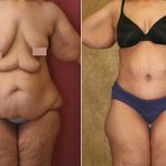 Tummy Tuck (Abdominoplasty) Super Plus Size Before & After Patient #12687