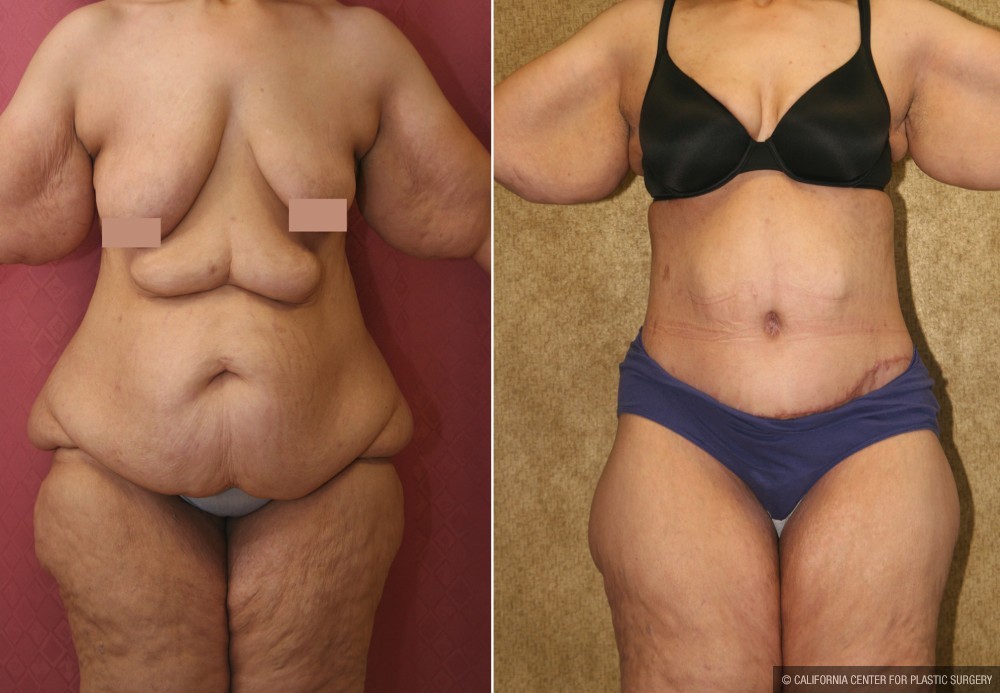 Tummy Tuck (Abdominoplasty) Super Plus Size Before & After Patient #12687