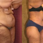 Tummy Tuck (Abdominoplasty) Super Plus Size Before & After Patient #12687