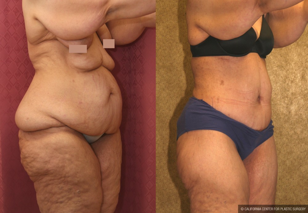 Tummy Tuck (Abdominoplasty) Super Plus Size Before & After Patient #12687