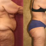 Tummy Tuck (Abdominoplasty) Super Plus Size Before & After Patient #12687