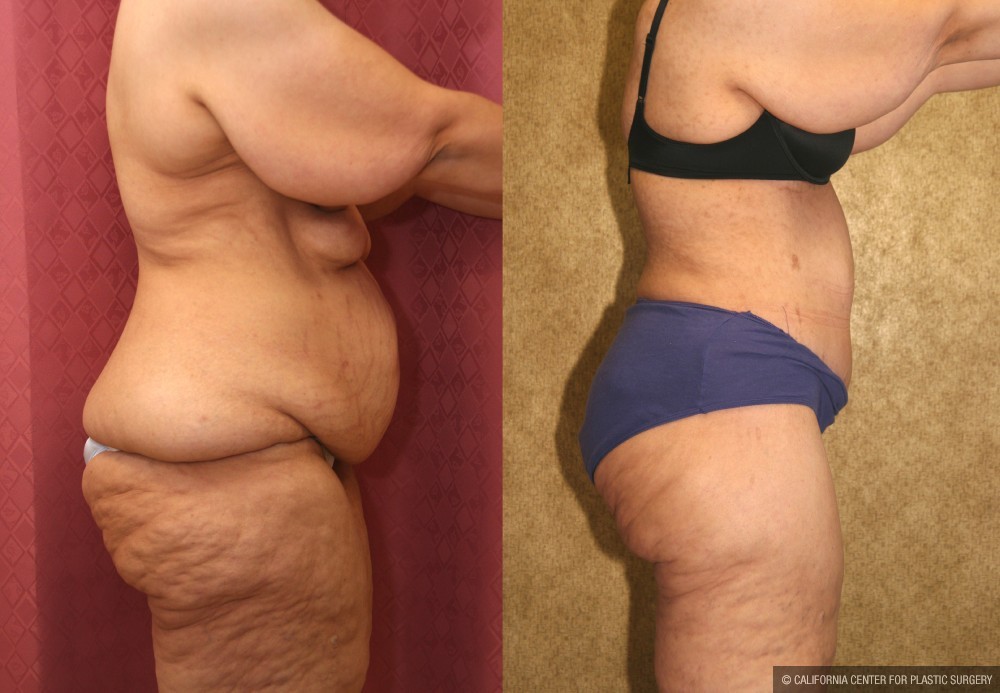 Tummy Tuck (Abdominoplasty) Super Plus Size Before & After Patient #12687