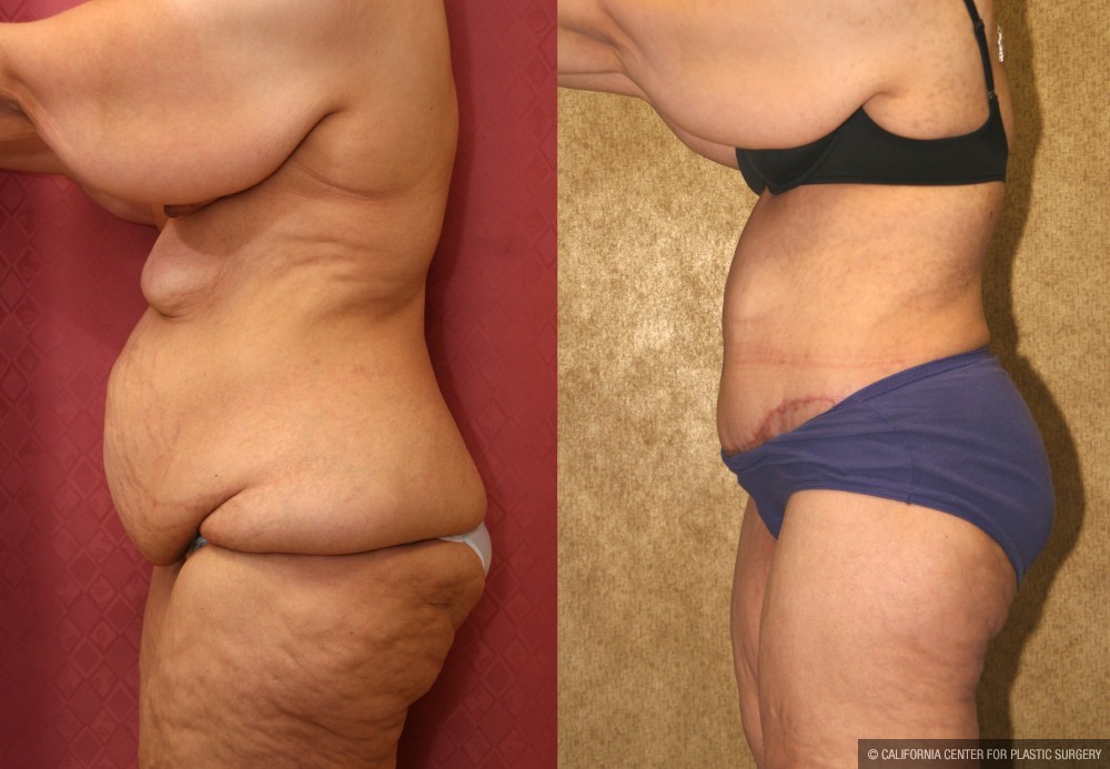 Tummy Tuck (Abdominoplasty) Super Plus Size Before & After Patient #12687