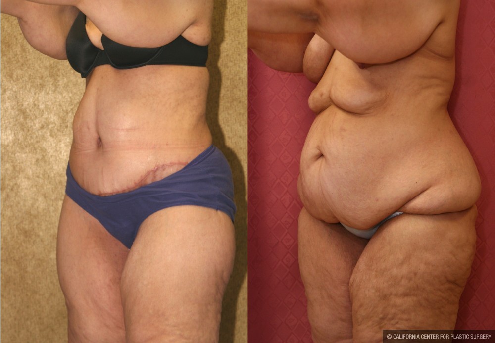 Tummy Tuck (Abdominoplasty) Super Plus Size Before & After Patient #12687