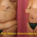 Tummy Tuck (Abdominoplasty) Super Plus Size Before & After Patient #12717