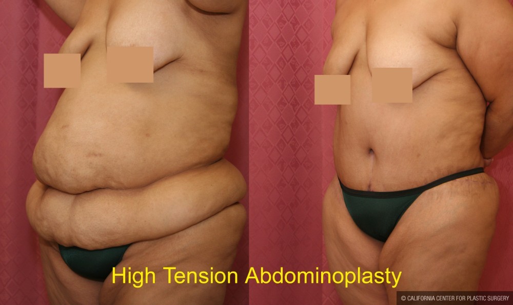 Tummy Tuck (Abdominoplasty) Super Plus Size Before & After Patient #12717