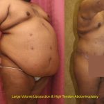 Tummy Tuck (Abdominoplasty) Super Plus Size Before & After Patient #12682