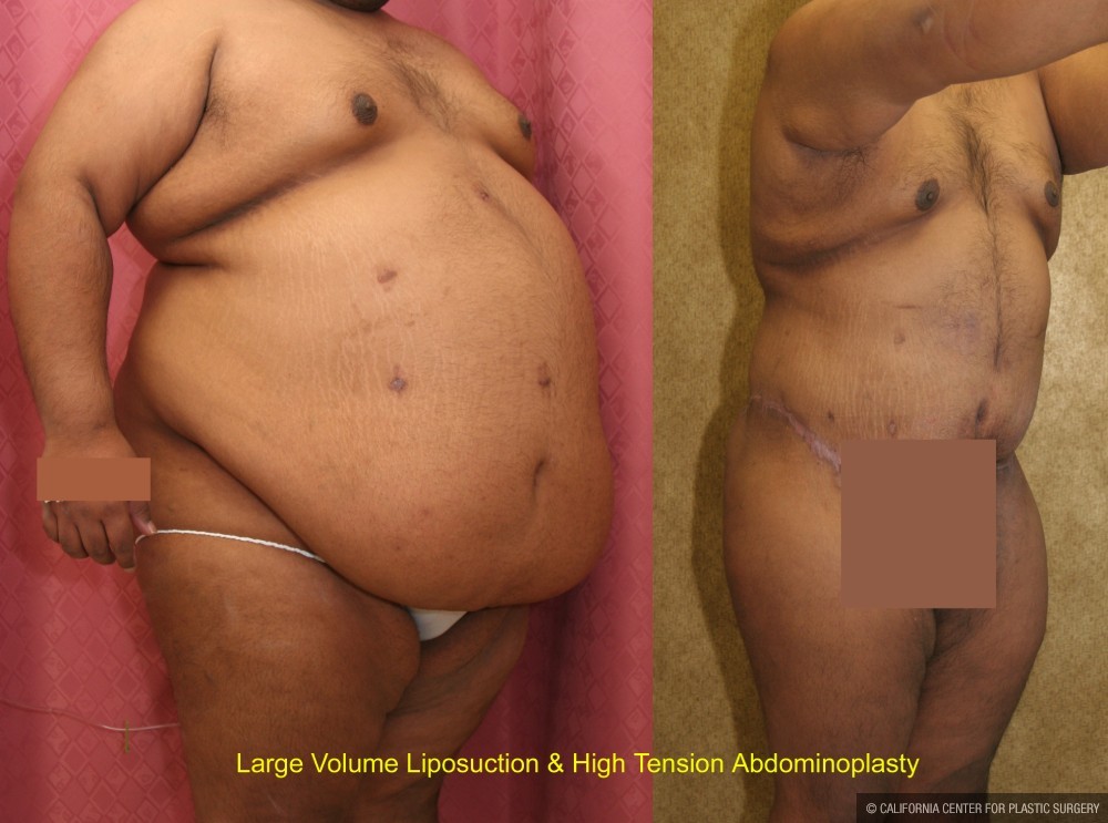Tummy Tuck (Abdominoplasty) Super Plus Size Before & After Patient #12682