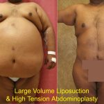 Tummy Tuck (Abdominoplasty) Super Plus Size Before & After Patient #12682