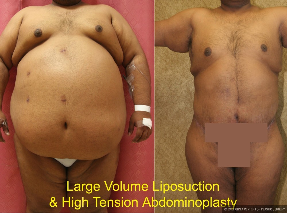 Tummy Tuck (Abdominoplasty) Super Plus Size Before & After Patient #12682