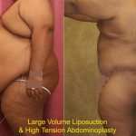 Tummy Tuck (Abdominoplasty) Super Plus Size Before & After Patient #12682