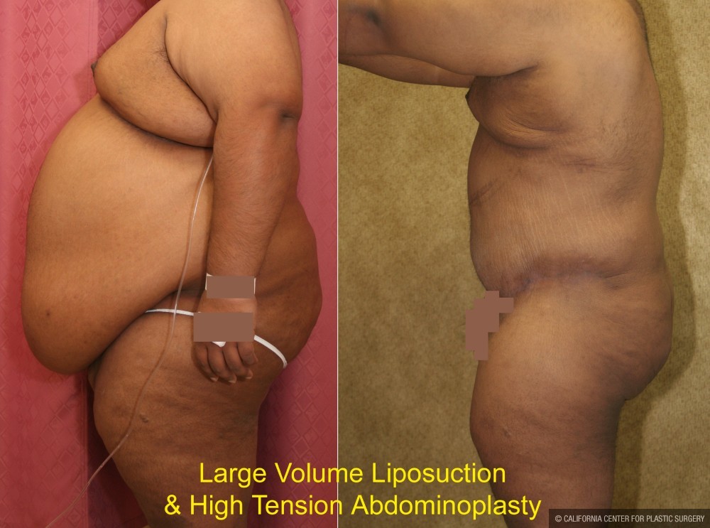 Tummy Tuck (Abdominoplasty) Super Plus Size Before & After Patient #12682