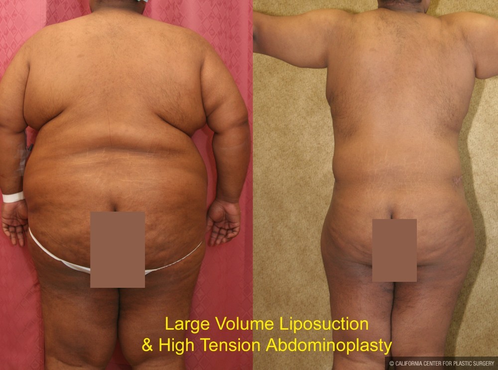 Tummy Tuck (Abdominoplasty) Super Plus Size Before & After Patient #12682