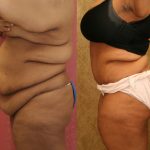 Tummy Tuck (Abdominoplasty) Super Plus Size Before & After Patient #12712