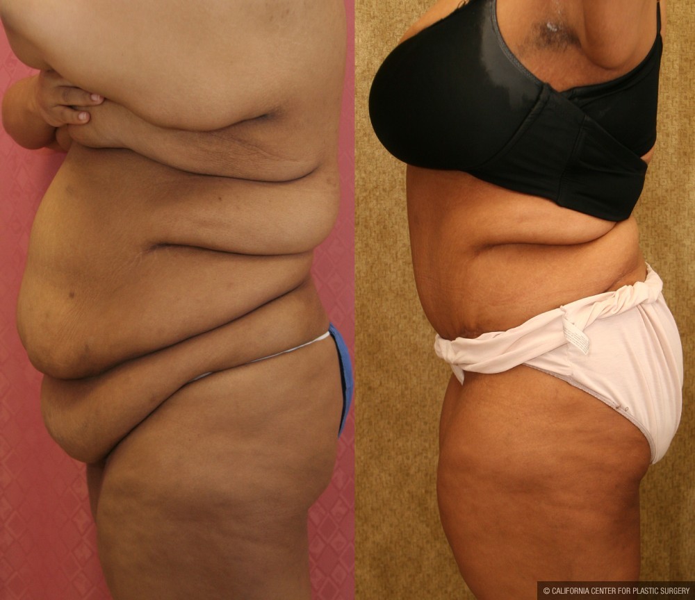 Tummy Tuck (Abdominoplasty) Super Plus Size Before & After Patient #12712