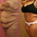 Tummy Tuck (Abdominoplasty) Super Plus Size Before & After Patient #12712