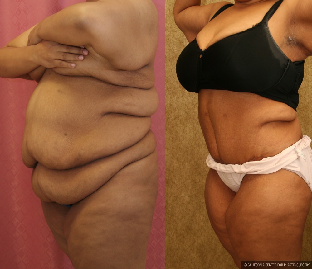 Tummy Tuck (Abdominoplasty) Super Plus Size Before & After Patient #12712