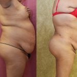 Liposuction Abdomen Plus Size Before & After Patient #12619