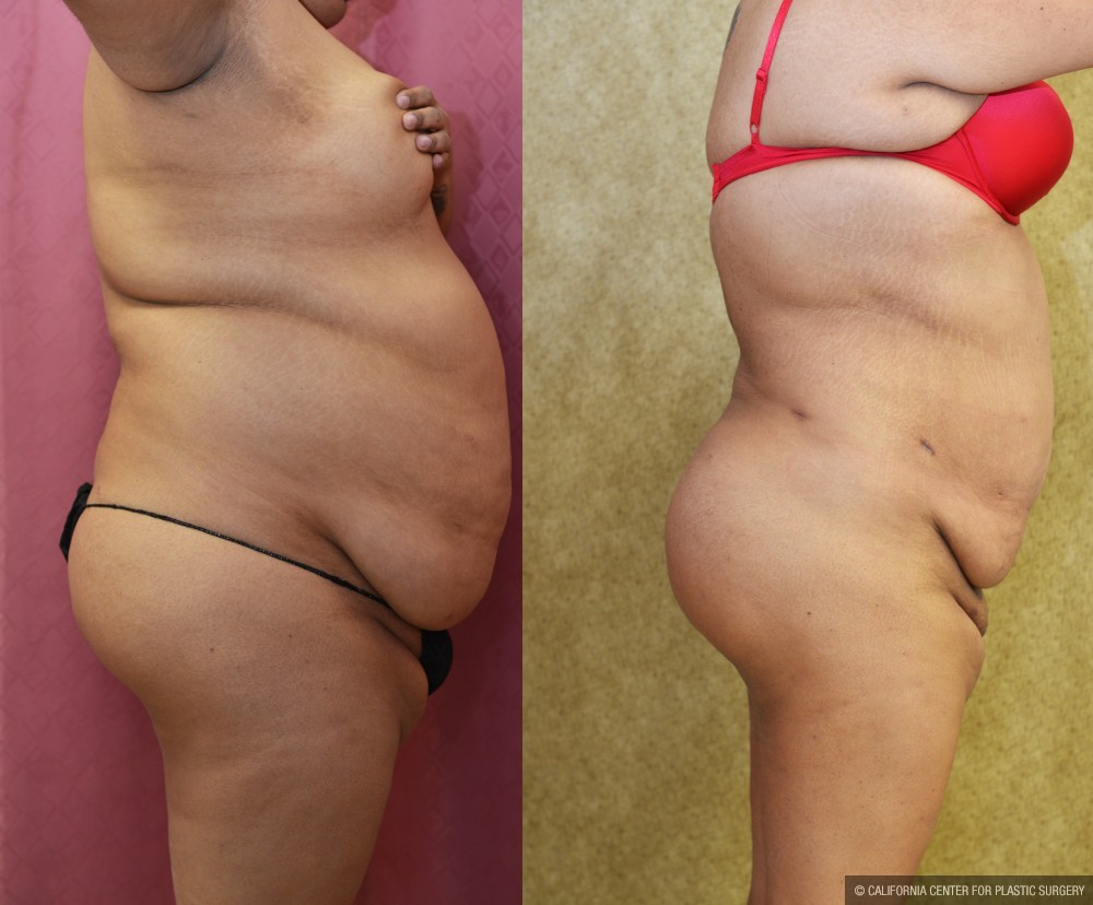 Liposuction Abdomen Plus Size Before & After Patient #12619
