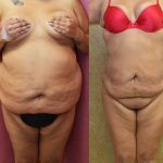 Liposuction Abdomen Plus Size Before & After Patient #12619