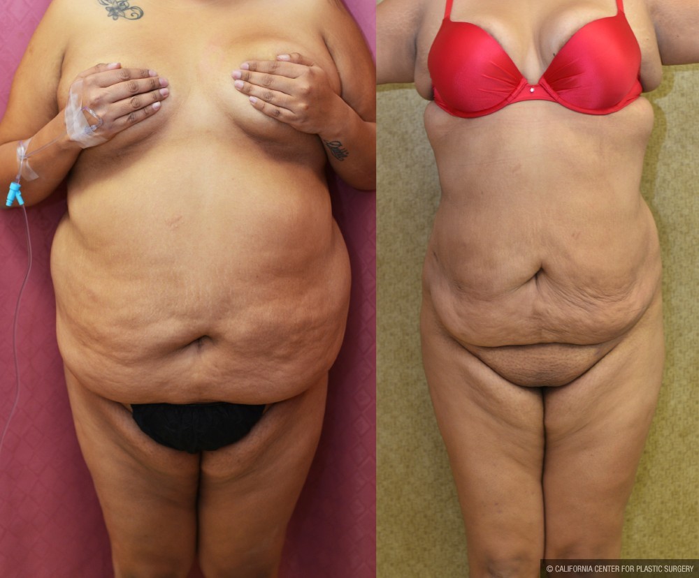 Liposuction Abdomen Plus Size Before & After Patient #12619