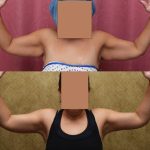 Arm Lift (Brachioplasty) Before & After Patient #12742