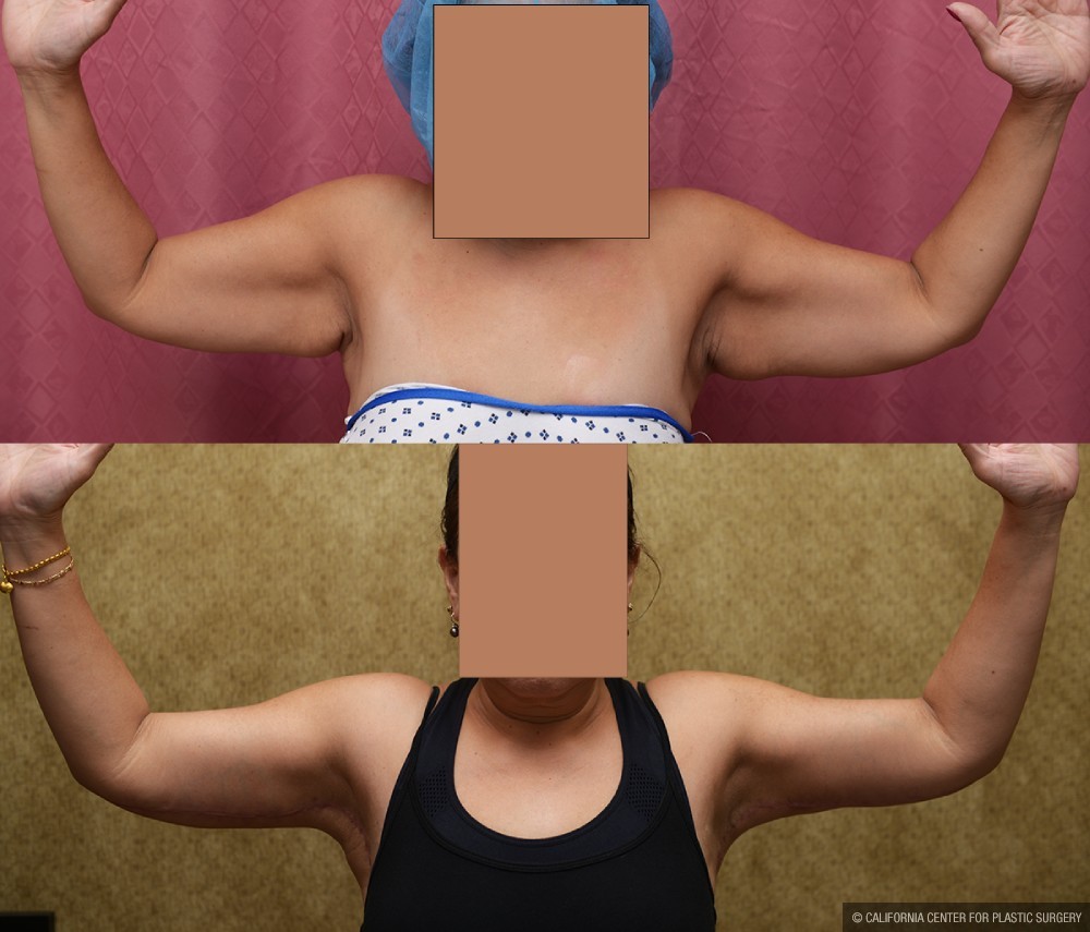 Arm Lift (Brachioplasty) Before & After Patient #12742