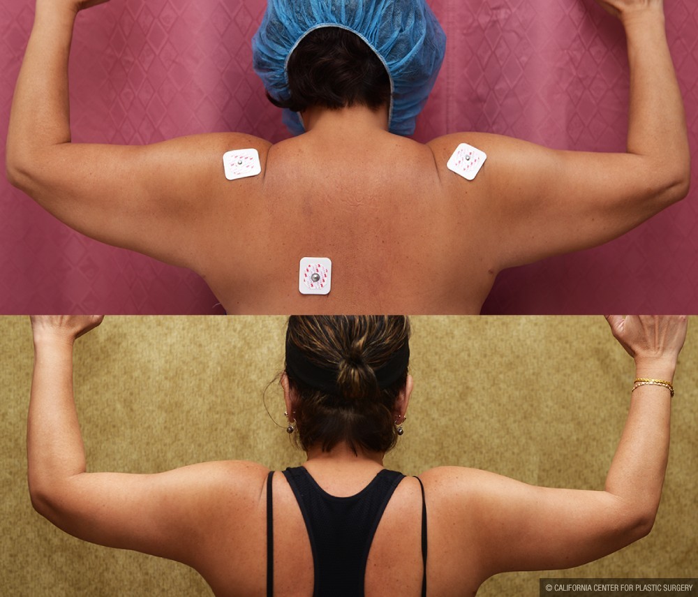Arm Lift (Brachioplasty) Before & After Patient #12742