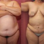 Tummy Tuck (Abdominoplasty) Super Plus Size Before & After Patient #12693