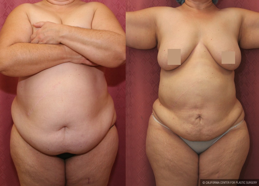 Tummy Tuck (Abdominoplasty) Super Plus Size Before & After Patient #12693