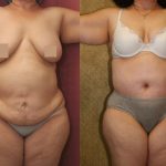 Tummy Tuck (Abdominoplasty) Super Plus Size Before & After Patient #12693